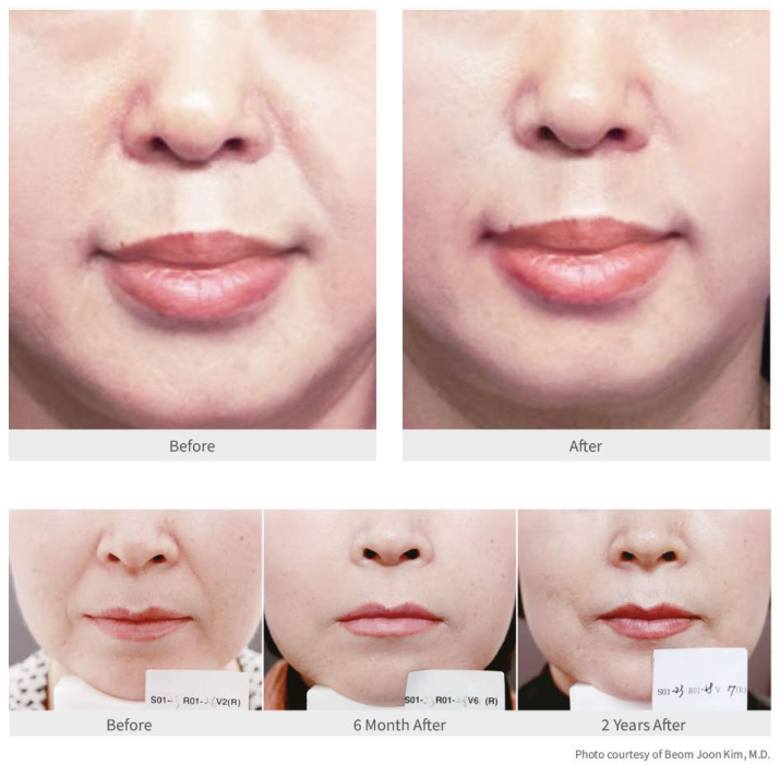 aestefill before after