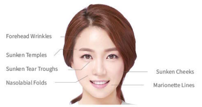 aestefill treatment areas