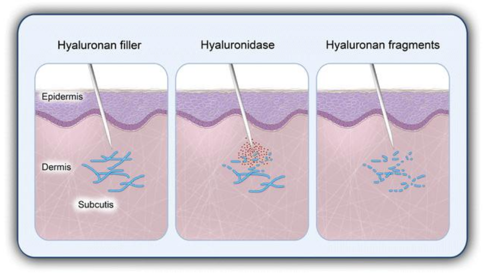 liporase filler dissolver