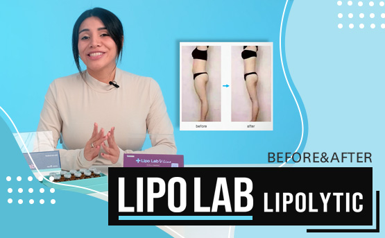 LIPO LAB Fat Dissolving Injections l Before & After Picture Results